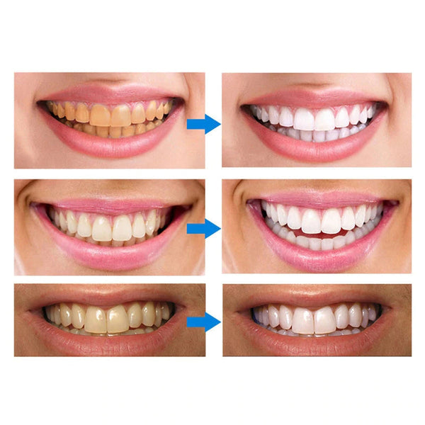 Stylo de Nettoyage et de Blanchiment des Dents